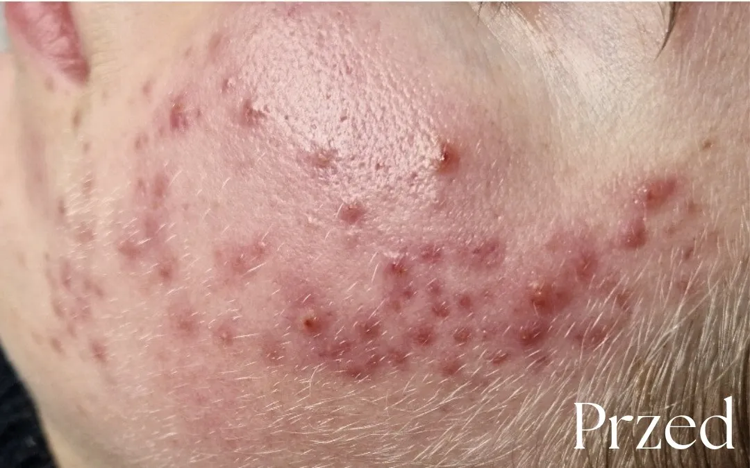 Trądzik o podłożu hormonalnym — przed terapią